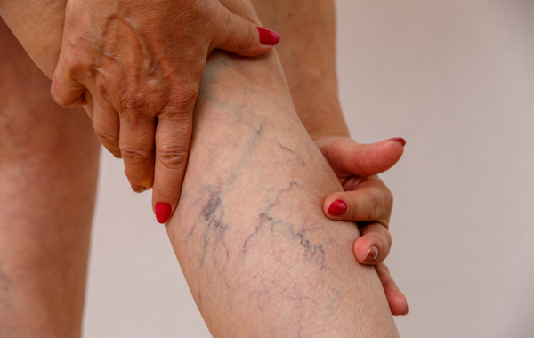 Varicose Vein Treatment