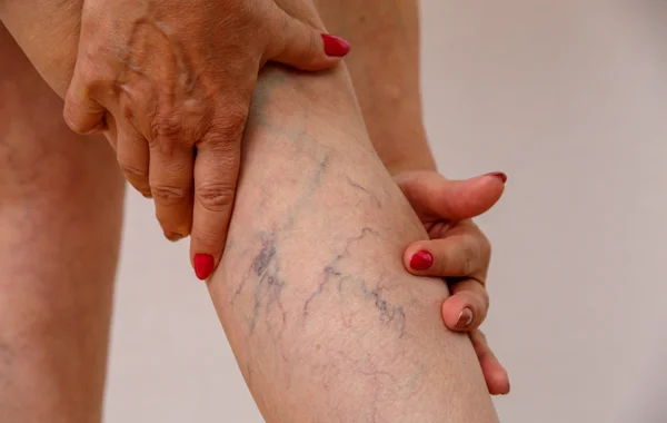 Varicose Vein Treatment