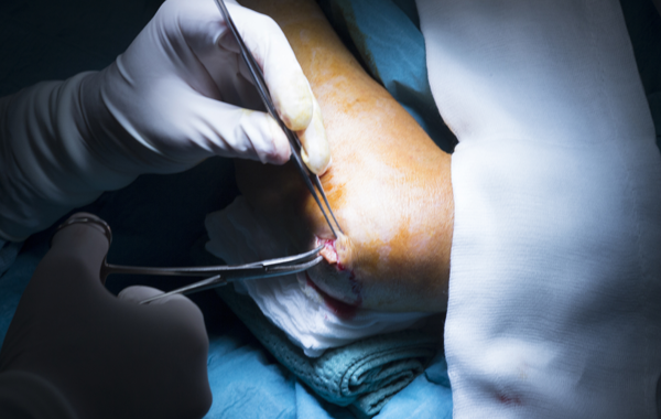 Soft-Tissue Tumor Surgery