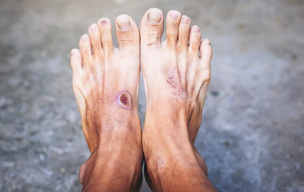 Diabetic Foot Surgeries